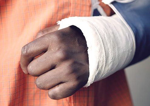 Broken Arm: Signs, Symptoms, & Treatments