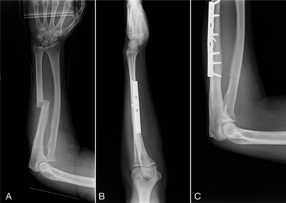 What Does A Fracture Look Like On An X Ray at Chester Andres blog