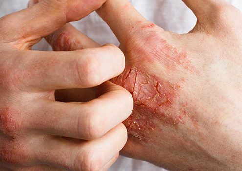 Psoriatic Arthritis