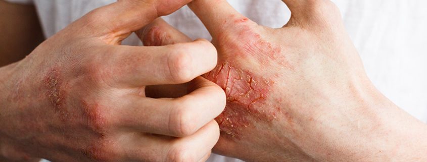 Psoriatic Arthritis