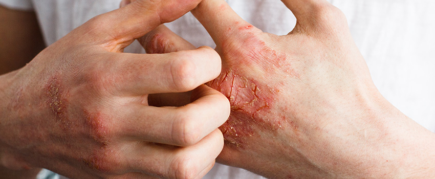 Does Psoriatic Arthritis Affect Internal Organs