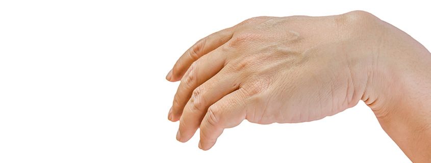 Ganglion Cysts