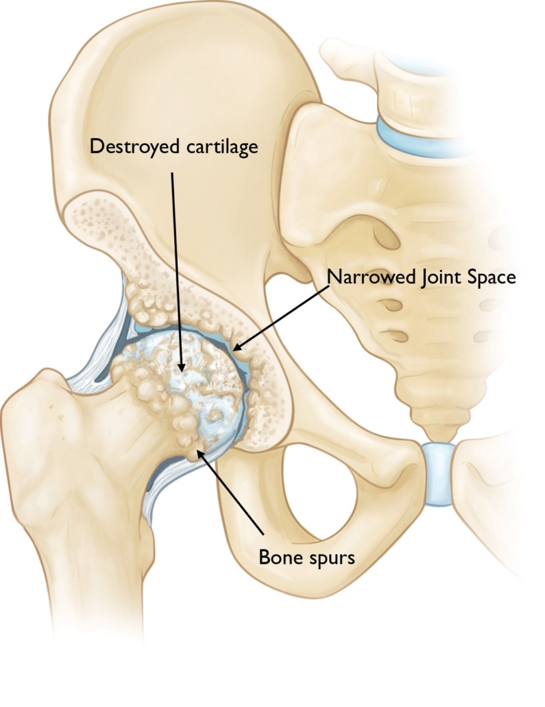 A hip damaged by osteoarthritis.