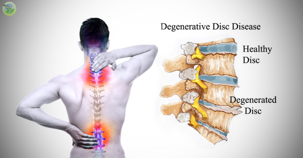 What Is Degenerative Disc Disease? - Orthopedic & Sports Medicine