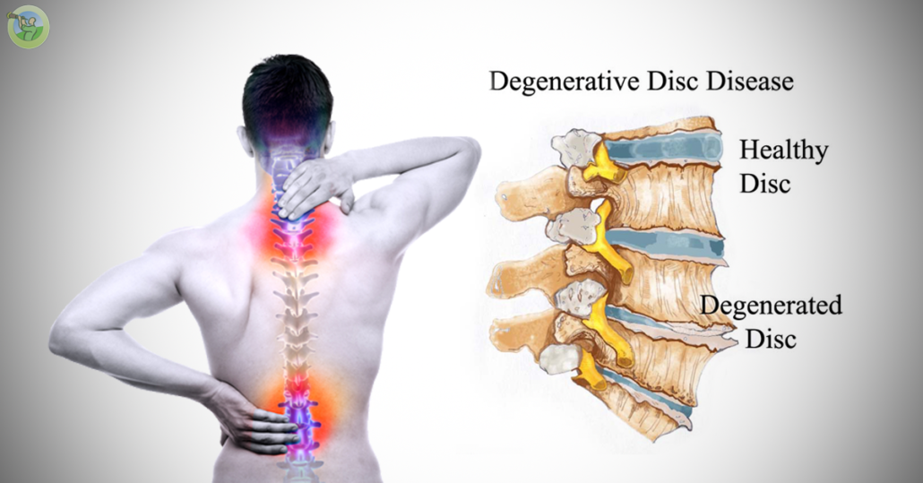 degenerative disease disc disk pain orthopedic