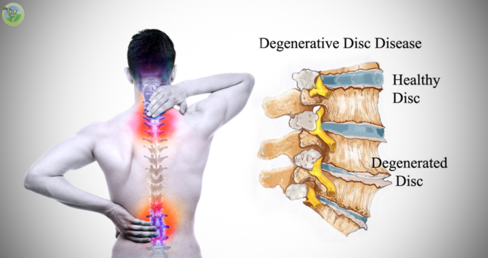 degenerative-disk-disease-orthopedic-sports-medicine