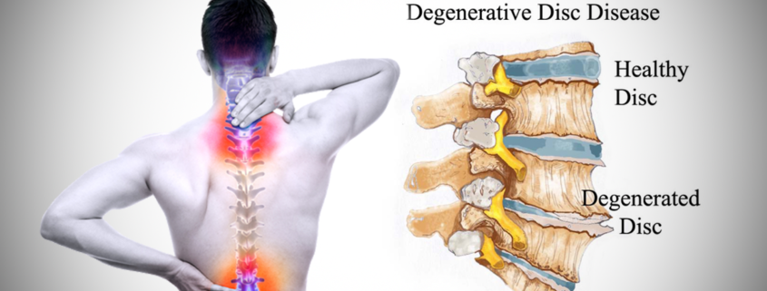 Types Of Back Surgery For Degenerative Disc Disease