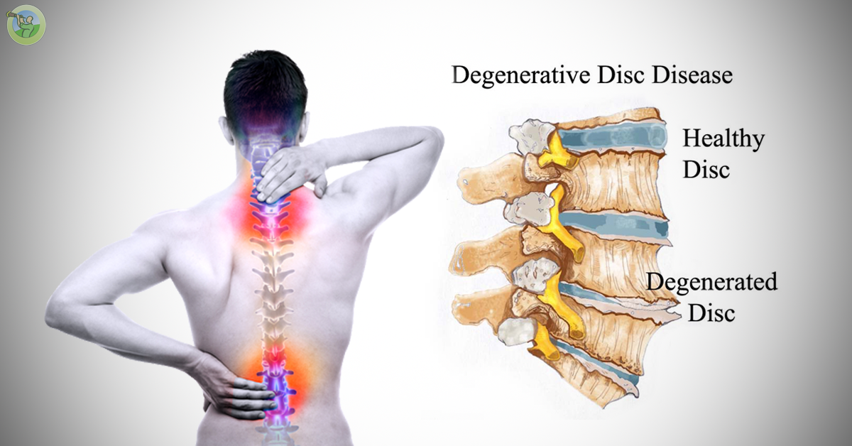 Degenerative Disk Disease