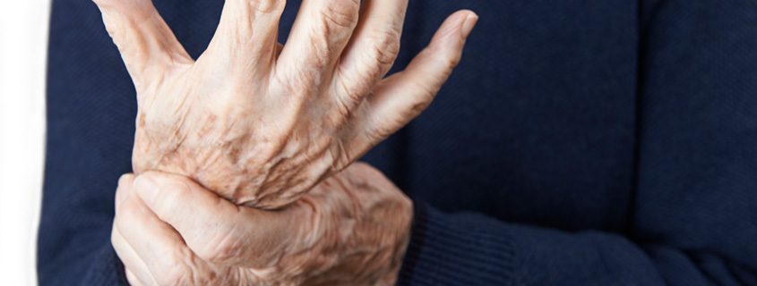 5 Ways to Help Prevent Arthritis