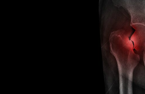 Fracture After Total Hip Replacement