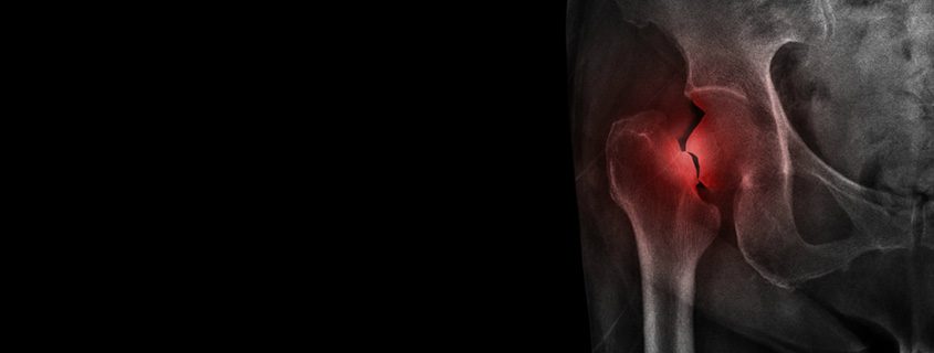 Fracture After Total Hip Replacement