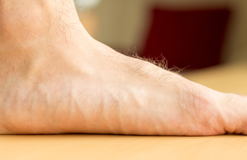 How to Tell if you Have Flat Feet: Symptoms of Flat Feet