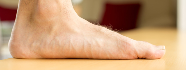 How To Tell If You Have Flat Feet Symptoms Of Flat Feet Orthopedic And Sports Medicine