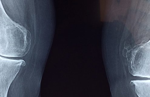 Why Knee Pain Could Be a Thing of the Past