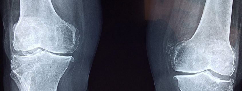 Why Knee Pain Could Be a Thing of the Past