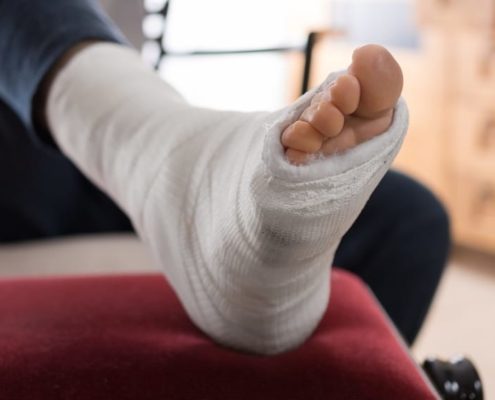 How to Treat Plantar Fasciitis