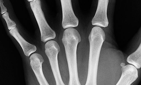 Bone Health for Life: Health Information Basics for You and Your Family