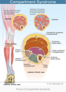 Diagram of Compartment Syndrome