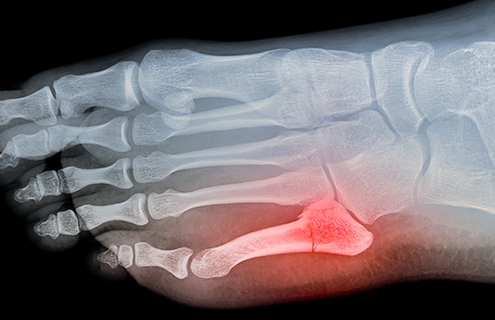 What you should know about a broken pinky toe
