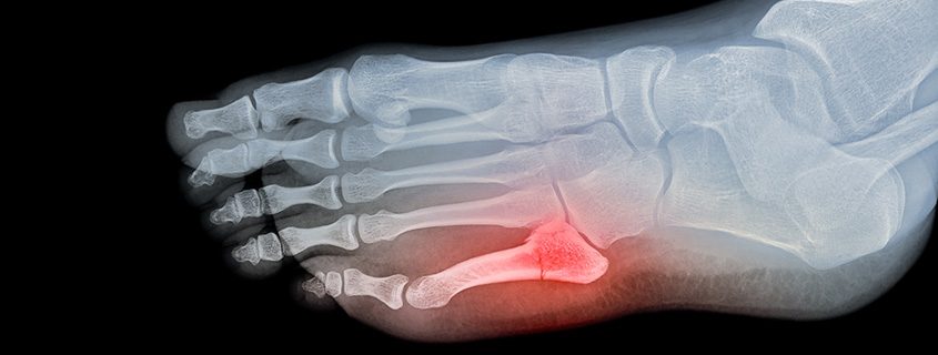 Running On A Broken Pinky Toe Online | emergencydentistry.com