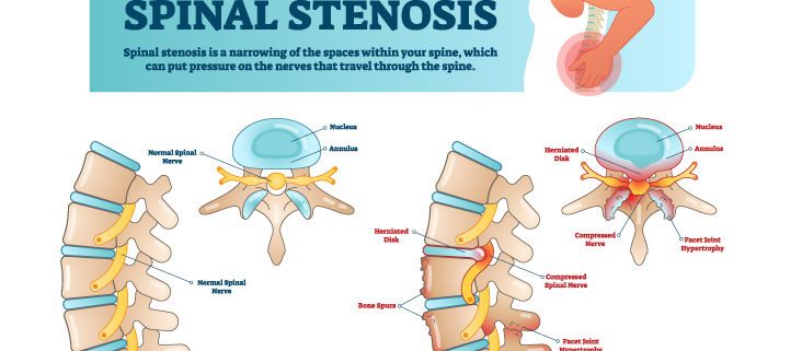 Spinal Stenosis  Diagnosing & Treatment Options: Progressive Spine &  Sports Medicine: Pain Medicine