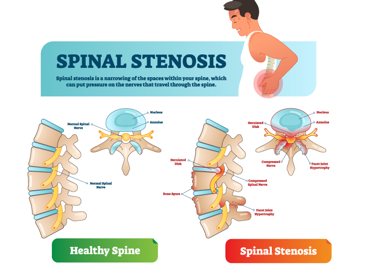 7 Facts You May Not Know About Spinal Stenosis