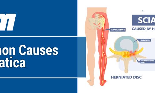 Common Causes of Sciatica