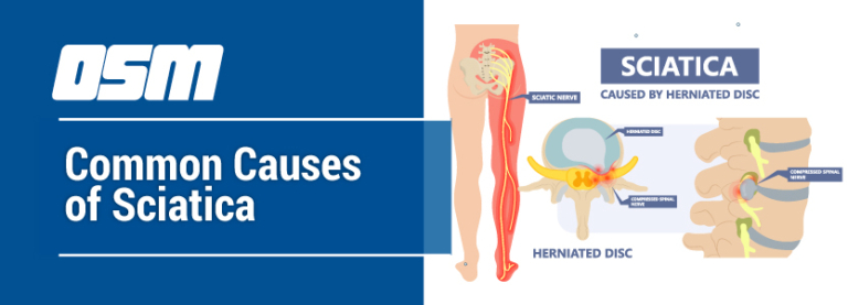 Common Causes Of Sciatica - Orthopedic & Sports Medicine