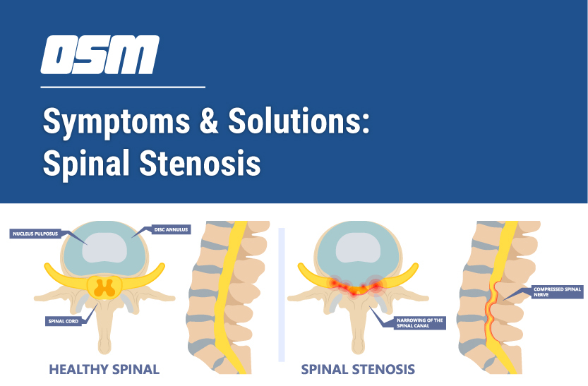 All You Need to Know About Spinal Stenosis