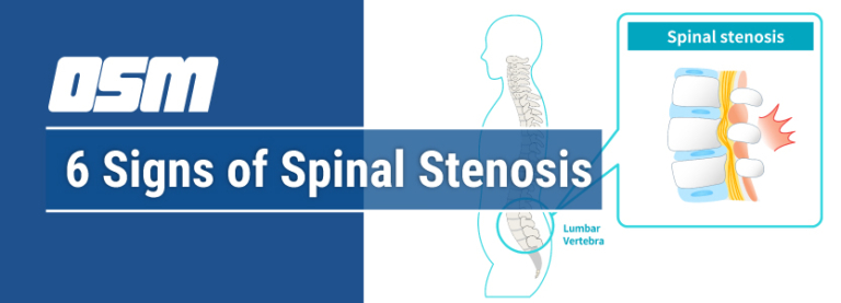 6 Signs Of Spinal Stenosis Orthopedic And Sports Medicine