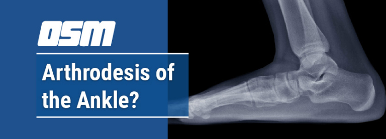 Arthrodesis of the Ankle - Orthopedic & Sports Medicine