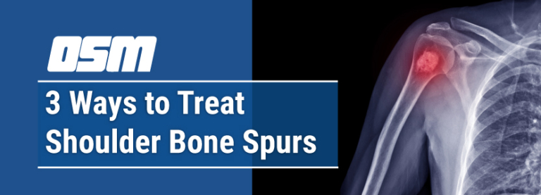 3 Ways To Treat Shoulder Bone Spurs - Orthopedic & Sports Medicine